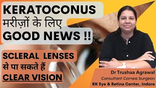 Scleral Contact Lenses : How to insert and remove  ? Now get clear vision in Keratoconus.