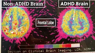 Brain Image Differences of Non ADHD vs ADHD