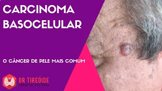 Carcinoma basocelular - O tipo mais comum de câncer de pele