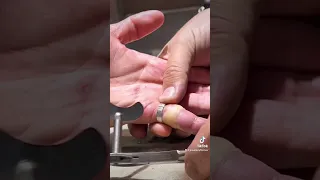 Cutting off a ring from a finger. Jewellery repair, jewelry, fix