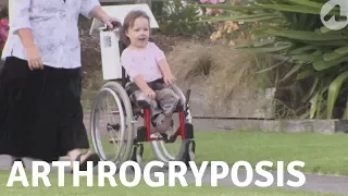 An Unusual Condition: Arthrogryposis