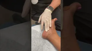 Cortisone Injection for Heel Pain (Plantar Fasciitis)