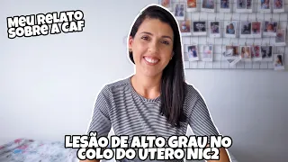 RELATO LESÃO DE ALTO GRAU NO COLO UTERINO-NIC2/CIRURGIA DE ALTO FREQUÊNCIA-CAF