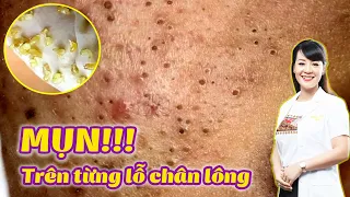 Điều trị mụn ẩn, mụn bọc hiệu quả tại TPHCM | Acne Treatment | Hiền Vân Spa | 596