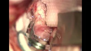 Microsurgical clipping of left posterior communicating artery aneurysm