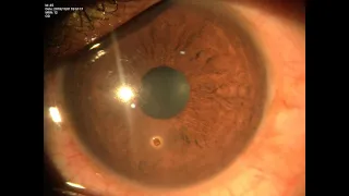 Superficial Corneal FB removal , Dr PL APPROACH