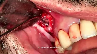 metal free Zirconia implant in sinus lift procedure