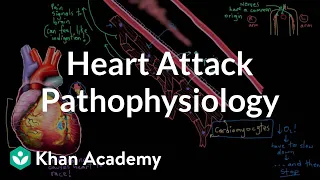 Heart attack (myocardial infarction) pathophysiology | NCLEX-RN | Khan Academy