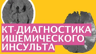 КТ-диагностика ишемического инсульта | Визуализация инсульта | Как выглядит ишемический инсульт?