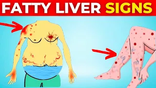 A Silent Threat: 8 Signs That Could Indicate Fatty Liver Disease | Health Hub