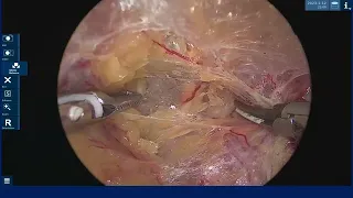 Laparoscopic pelvic Anatomy :part 1.Lateral pararectal space :most important pelvic space .