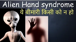 Alien hand syndrome | what is alien hand syndrome? | Alien hand syndrome in Hindi | Anarchic hand