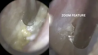 172 - Infectious Debris & Squames of Dead Skin Removed off Eardrum using the WAXscope®️