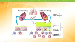 Miller_Current Trends In Asthma Part I