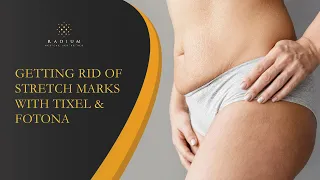 Getting Rid of Stretch Marks with Tixel and Fotona