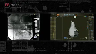 Cardioneuroablation for severe neurally mediated syncope