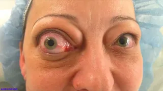 Thyroid associated orbitopathy (thyroid eye disease)