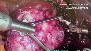 Хирургическое лечение миомы матки.  Интралигаментарный узел