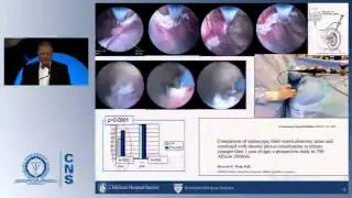 Special Lecture: The Echternach Procession Towards Optimal Hydrocephalus Treatment