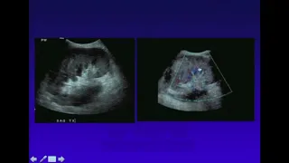 Ultrasound evaluation of  Renal, Liver and Pancreas Transplants