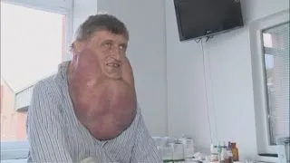 Man has giant six kilogramme tumour removed from his face