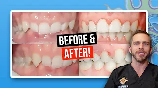 Severe Deep Bite: BEFORE AND AFTER BRACES