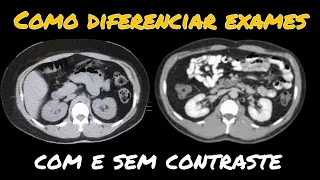 Como diferenciar exames sem contraste e com contraste na Tomografia Computadorizada?