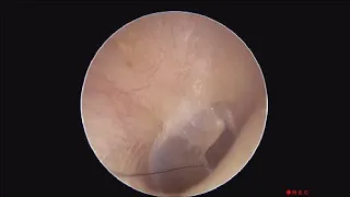 Hair Piece In The Ear Passage Touching Eardrum Causing Discomfort