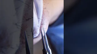 ingrown hair pull out speedx2 with tweezers!  Satisfying 241 #shorts #satisfying  #well  #removal