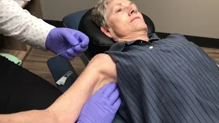 Treating Frozen Shoulder With Dry Needling