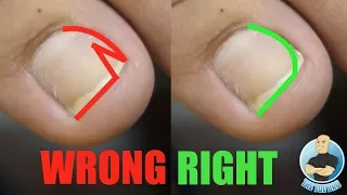 EASY DIY AT HOME TREATMENT FOR INGROWN TOENAILS USING INGROWN TOENAIL TOOL