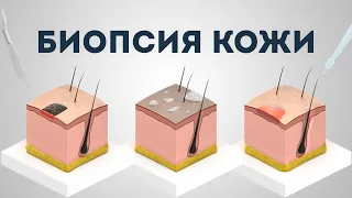 Биопсия кожи