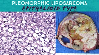 Pleomorphic liposarcoma (epithelioid type) (Oregon Case 15) pathology sarcoma spindle cell neoplasm