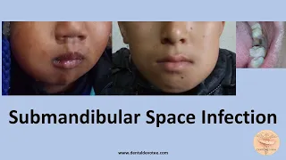 Submandibular Space Infection - Treatment by Dr. Raman Dhungel