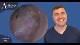 EAR WAX REMOVAL WITH AGGRAVATED EARDRUM- EP778