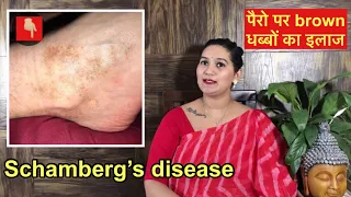 Brown spots on legs | Schamberg’s disease treatment | पैरो में काले काले दाग का इलाज