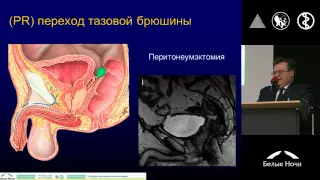 Современные возможности хирургического лечения рака прямой кишки