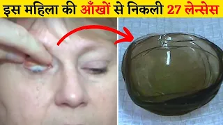 इस महिला की आँखों से निकली 27 लेन्सेस  😱 Doctors find 27 lenses in woman's eyes #shorts #facts