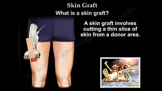Skin Graft - Everything You Need To Know - Dr. Nabil Ebraheim