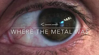 Metal Removal In Eye With A Magnet 🧲