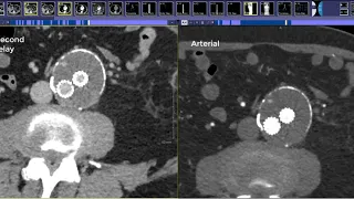 How to read an Endograft CTA