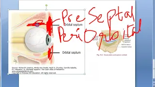 Ophthalmology 417 a Orbital Infection Orbital Cellulitis PreSeptal Post Septal Eye Swelling