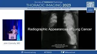 Radiographic Appearances of Lung Cancer