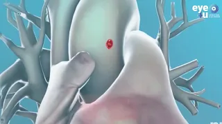 Fibrilação Atrial - Vídeo em 3D