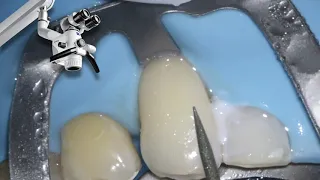White Composite Filling Done Without Drilling Away the Tooth | Culver City Dentist | Dr. Shayesteh