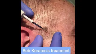 Seborrheic Keratosis 'Age Spots' Removal with Radiosurgery - London Skin Clinics