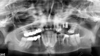 Direct sinus lift procedure (@dr.shivsharma6331)