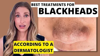 Blackheads: Dermatologist Shares Best Treatments to Remove Them with Affordable Skincare Options