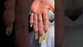 Онихогрифоз на руках / Толстые желтые длинные ногти на руках Что делать?