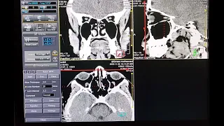 شرح فحص الاشعه المقطعيه علي حجاج العين علي جهاز توشيبا / CT Scan Of The  Orbit